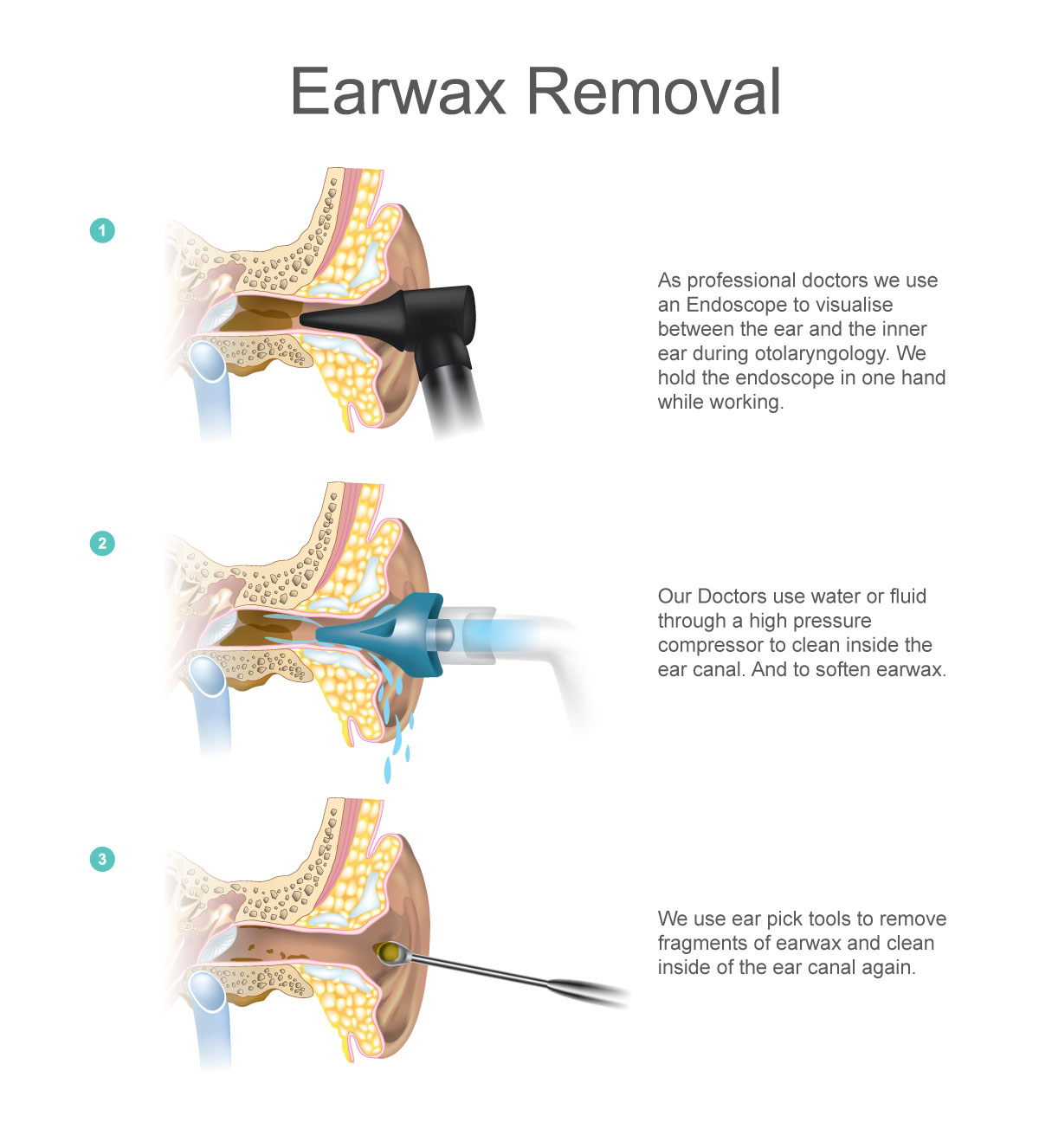 ear wax camera removal